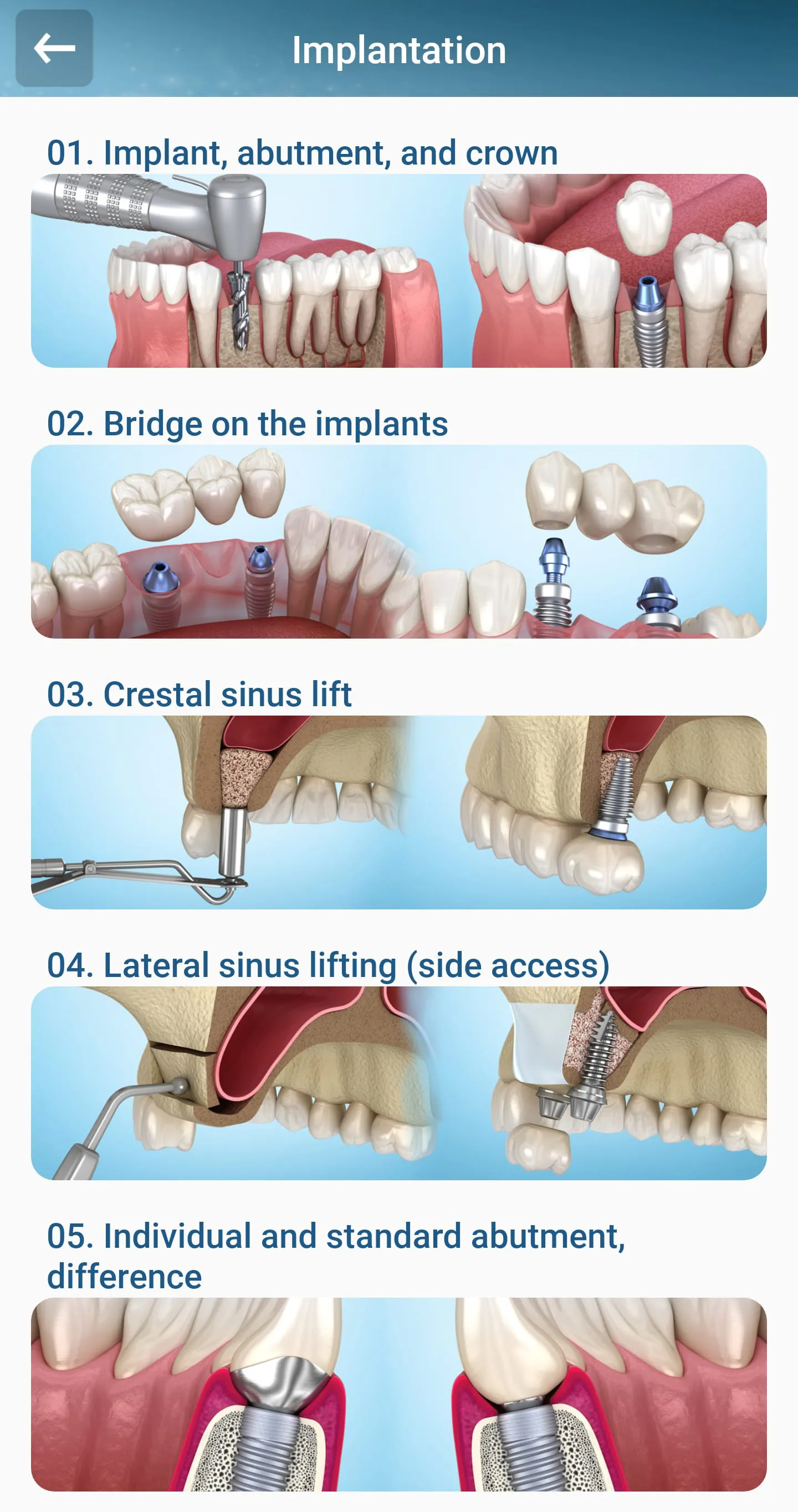 Dental 3D Illustrations